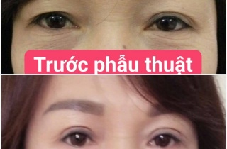 SỰ KHÁC NHAU GIỮA NHẤN MÍ VÀ CẮT MÍ
